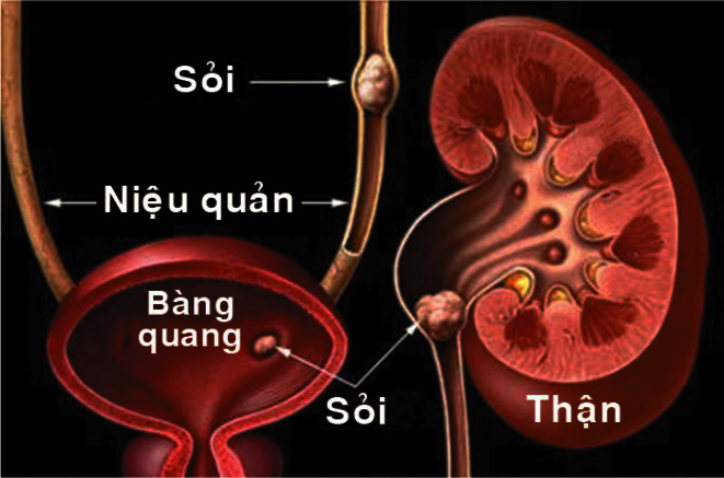 sỏi thận